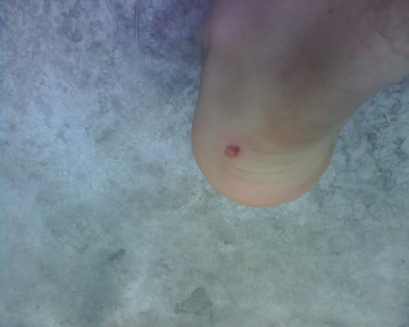 heel blister