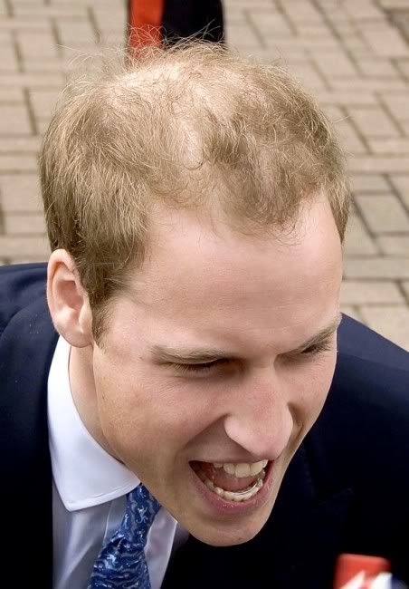 prince william hairline. Prince William and Kate Middleton are one of the hot topics this year because they#39;re soon to get married, right? Let#39;s just focus on Prince William for now
