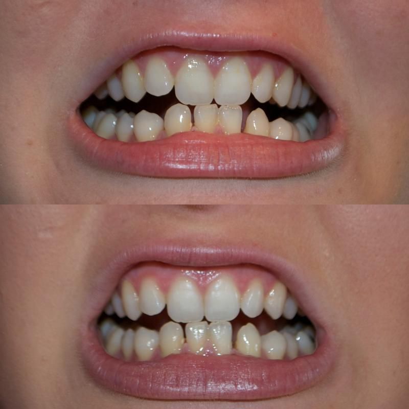 teeth comparison