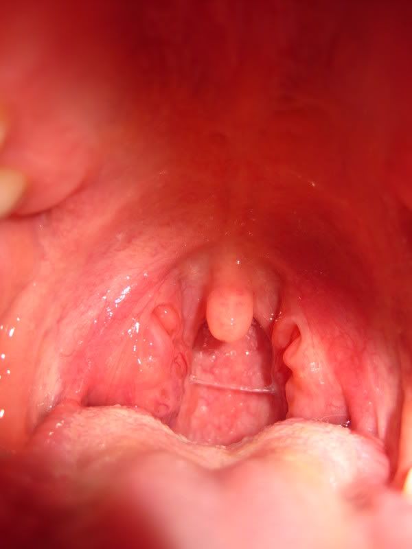 Lump On Tonsil