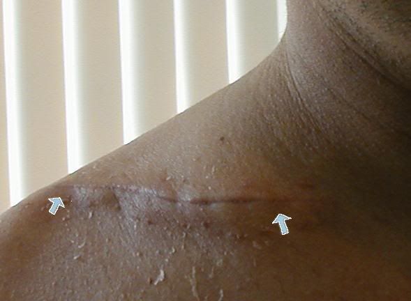 clavicleincision5inches.jpg
