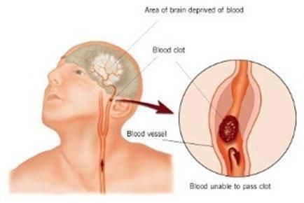 stroke_zps41464937.jpg